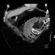 Migration of stent, ileus: CT - Computed tomography